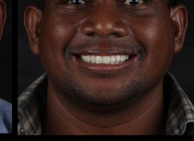 After Immediate Loading