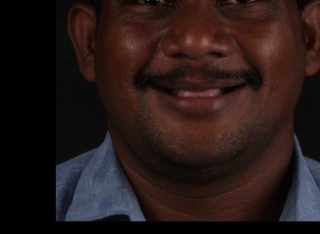 Before Immediate Loading