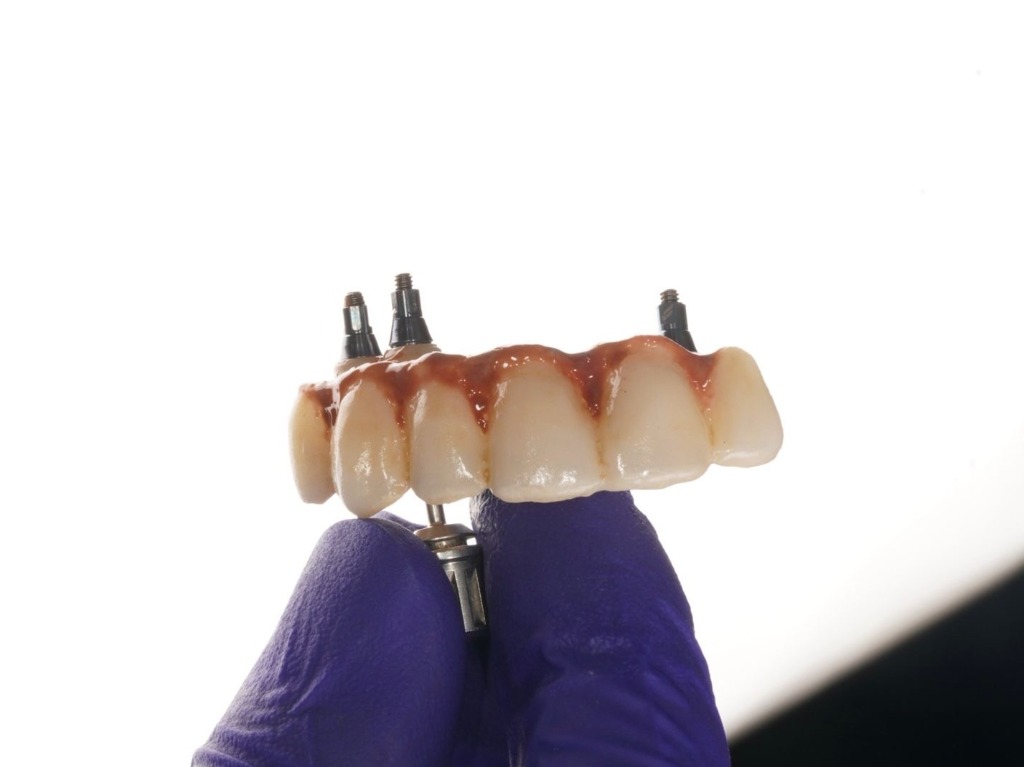 Implant Bridge